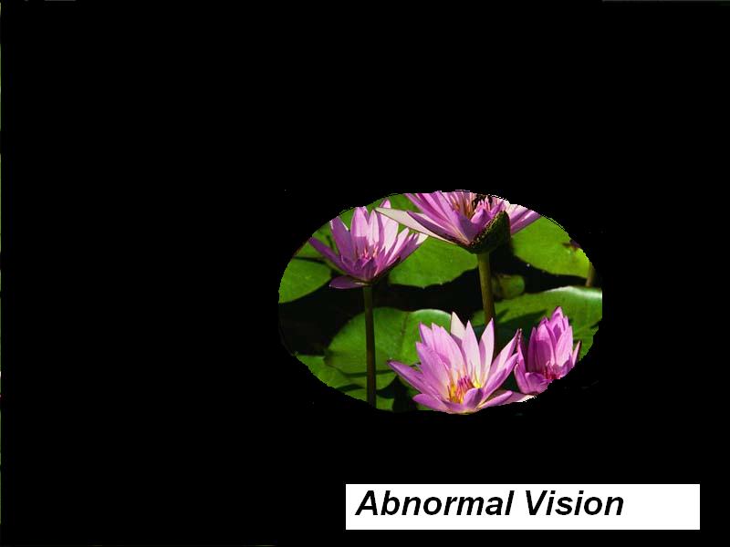 MRCP-abnormal vision