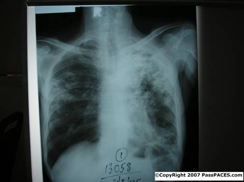 Tuberculosis for MRCP