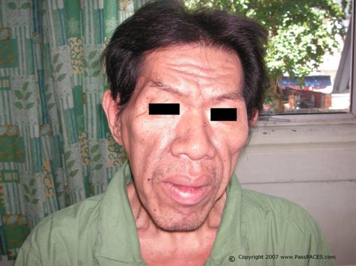 Acromegaly for MRCP