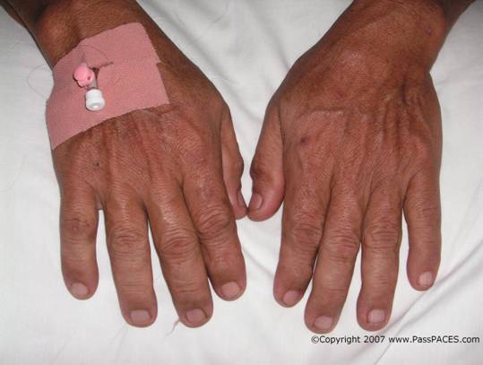 acromegaly for MRCP 3