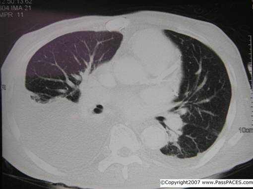 CT thorax