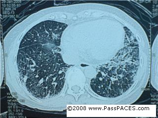 lung fibrosis