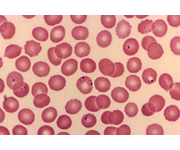 MRCP-blood film
