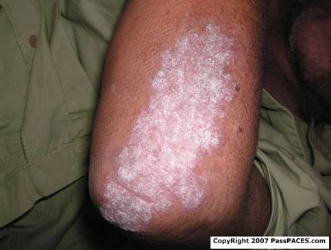 psoriasis for MRCP PACES